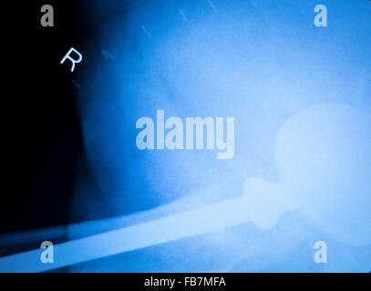 Anca artritiche xray scansione di prova ortopedia e traumatologia risultati che mostrano il titanio anca la piastra e le viti impianto chirurgico. Foto Stock