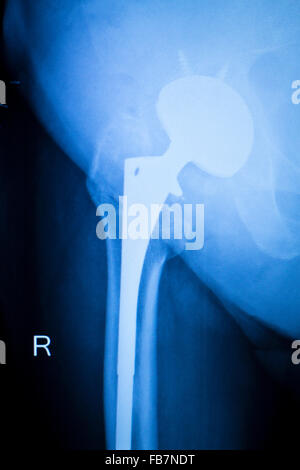 Anca artritiche xray scansione di prova ortopedia e traumatologia risultati che mostrano il titanio anca la piastra e le viti impianto chirurgico. Foto Stock