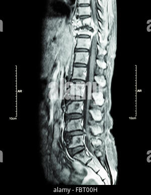 La colonna vertebrale metastasi ( la diffusione del cancro alla colonna vertebrale toracica ) ( MRI della colonna toracica e lombare : Mostra colonna toracica metastasi e com Foto Stock