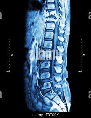 La colonna vertebrale metastasi ( la diffusione del cancro alla colonna vertebrale toracica ) ( MRI della colonna toracica e lombare : Mostra colonna toracica metastasi e com Foto Stock