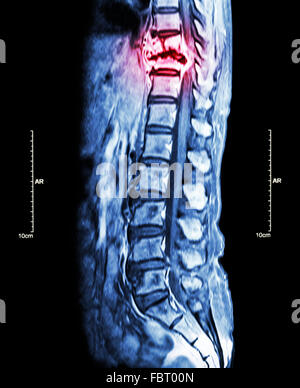 La colonna vertebrale metastasi ( la diffusione del cancro alla colonna vertebrale toracica ) ( MRI della colonna toracica e lombare : Mostra colonna toracica metastasi e com Foto Stock