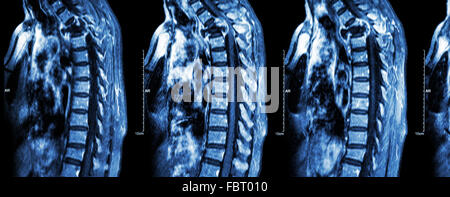 La colonna vertebrale metastasi ( la diffusione del cancro alla colonna vertebrale toracica ) ( MRI della colonna vertebrale cervicale e toracica : Mostra colonna toracica metastasi e c Foto Stock
