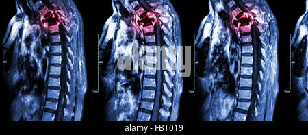 La colonna vertebrale metastasi ( la diffusione del cancro alla colonna vertebrale toracica ) ( MRI della colonna vertebrale cervicale e toracica : Mostra colonna toracica metastasi e c Foto Stock