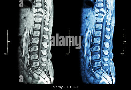 La colonna vertebrale metastasi ( la diffusione del cancro alla colonna vertebrale toracica ) ( MRI della colonna toracica e lombare : Mostra colonna toracica metastasi e com Foto Stock