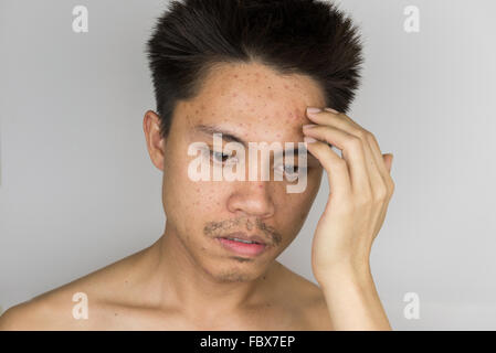 Brufolo sulla pelle uomo, spingendo fuori l'acne Foto Stock