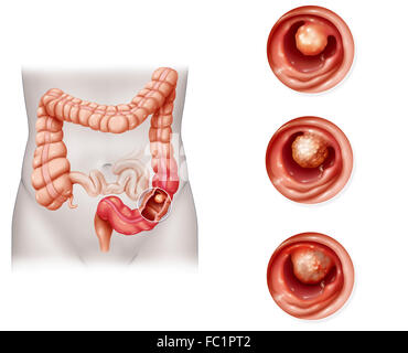 Il cancro del colon, disegno Foto Stock