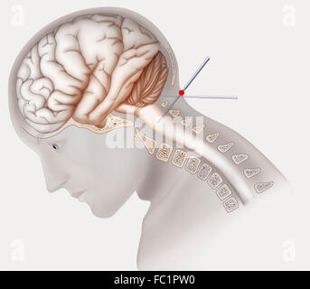 L'agopuntura, disegno Foto Stock