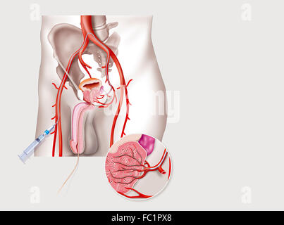 Prostatica embolizzazione arteriosa Foto Stock