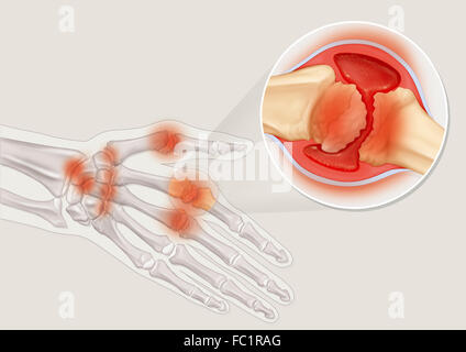 Artrite Reumatoide, disegno Foto Stock