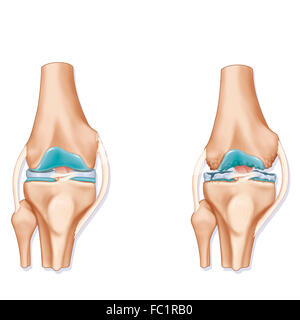 Osteoartrite, illustrazione Foto Stock