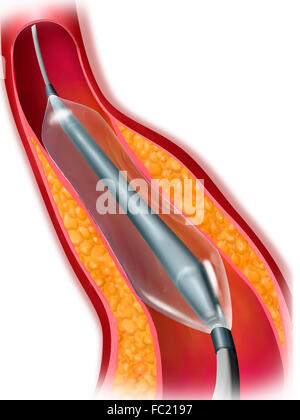 Angioplastica arteriosa, disegno Foto Stock