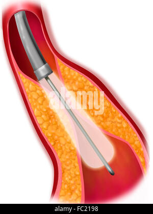 Angioplastica arteriosa, disegno Foto Stock