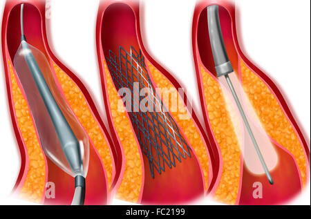 Angioplastica arteriosa, disegno Foto Stock