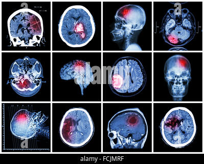 Raccolta di malattia del cervello ( scansione CT e MRI del cervello : mostra infarto cerebrale , emorragia intracerebrale , tumore al cervello , basal Foto Stock