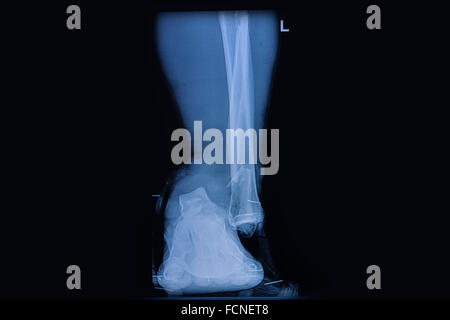 Frattura della parte inferiore del perone, vista frontale X-ray Foto Stock