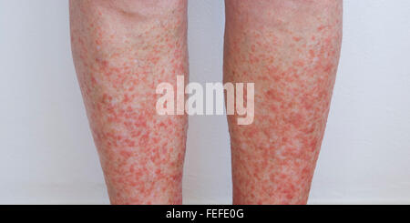 Donna di abbassare le gambe presentante il pruriginoso associato con un grave caso di luce polimorfica eruzione. Foto Stock