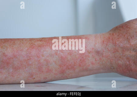 Donna di avambraccio che esibisce il pruriginoso associato con un grave caso di luce polimorfica eruzione. Foto Stock