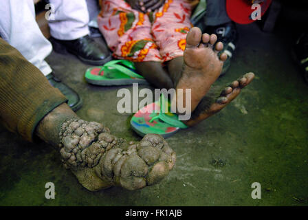 Un uomo con Podoconiosi infiammatorio cronico nei suoi piedi. Nord Kivu, Repubblica Democratica del Congo Africa Foto Stock