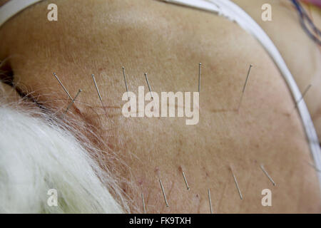 La donna riceve un trattamento di agopuntura della salute Foto Stock