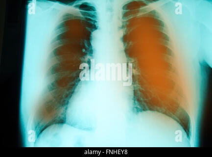 Petto di un esame a raggi x per la diagnosi La tubercolosi polmonare infezione con entrambi i polmoni Foto Stock