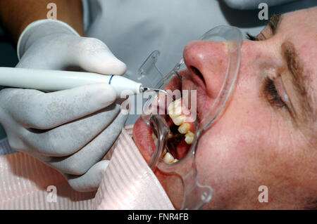 Un dentista rimozione della placca e del tartaro da un uomo di denti per evitare di cavità e altri problemi peridontal Foto Stock