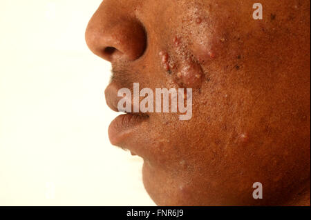 Vista laterale della metà inferiore della faccia di un ventunenne maschi affetti da acne vulgaris. L'acne vulgaris è un disturbo della pelle Foto Stock