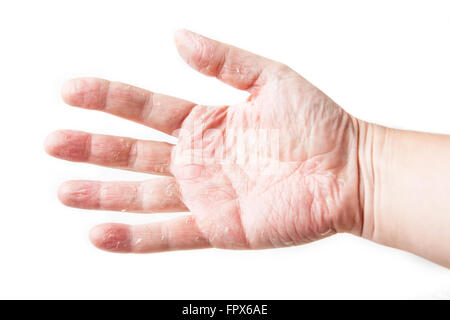 La malattia della pelle. Allergia della pelle Patch test sul retro del paziente che mostra il rossore e gonfiore. dermatite Foto Stock