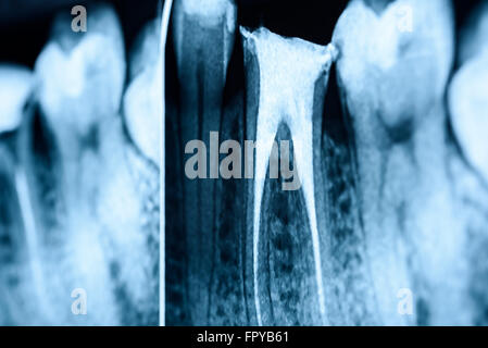 Scleroterapia completo del canale radicolare sistemi sui denti X-Ray Foto Stock