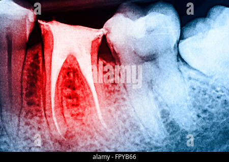 Scleroterapia completo del canale radicolare sistemi sui denti X-Ray Foto Stock