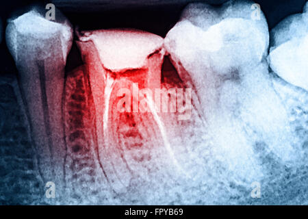 Scleroterapia completo del canale radicolare sistemi sui denti X-Ray Foto Stock