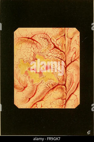 Questo lavoro medico del 1870 fornisce approfondimenti anatomici e clinici dettagliati sull'epilessia, concentrandosi su fisiopatologia, sintomi e trattamenti. Include incisioni e piastre originali per ulteriori studi e riferimenti. Foto Stock