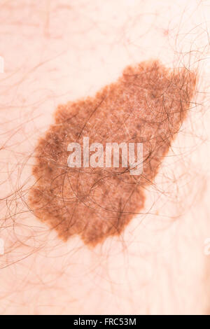 Il melanoma angioma bellezza mark Foto Stock