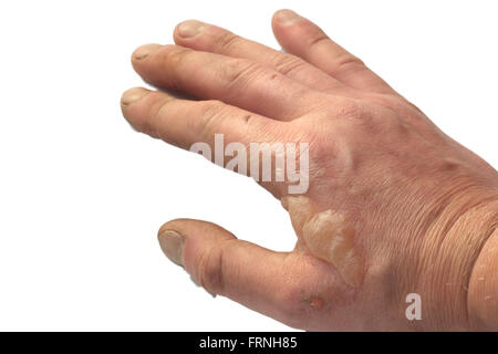 Brucia a mano su sfondo bianco Foto Stock