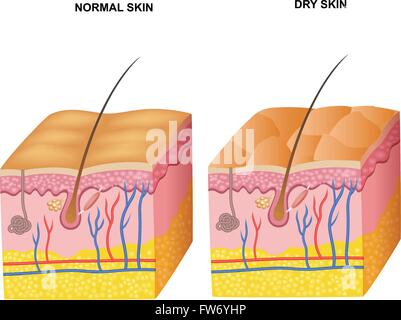Illustrazione degli strati della pelle normale e pelle secca Illustrazione Vettoriale