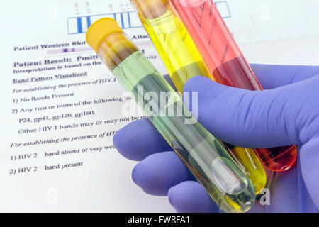 Campione di sangue e la richiesta di laboratorio per anti-HIV Test Foto Stock