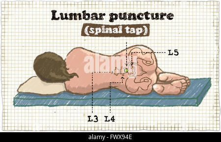 Puntura spinale illustrazione Foto Stock