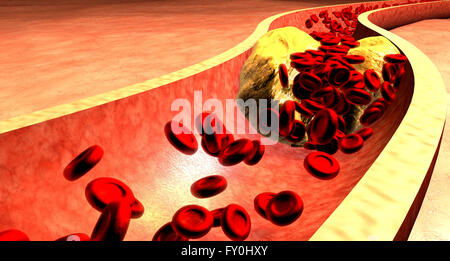 Arteria intasati con piastrine e la placca di colesterolo. L'aterosclerosi. Formazione della placca fibrosa. Foto Stock