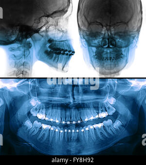 Panoramica dentale radioprahy x-ray con apparecchi fissi Foto Stock