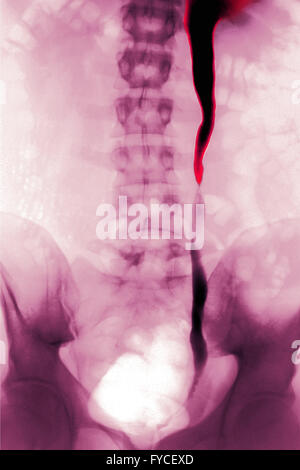 NEPHRITIC colica, RAGGI X Foto Stock