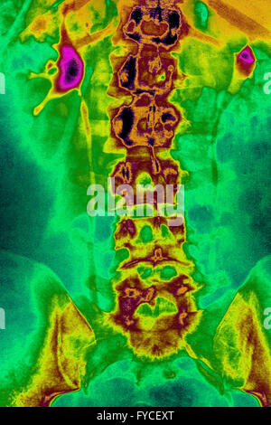 NEPHRITIC colica, RAGGI X Foto Stock