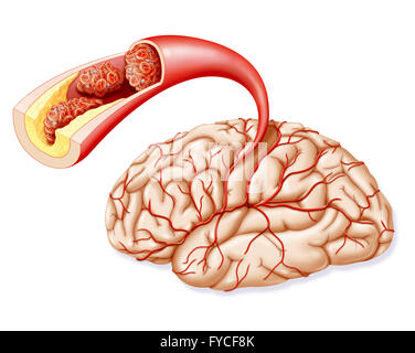 Accidente cerebrovascolare Foto Stock