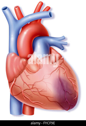 Attacco di cuore, disegno Foto Stock