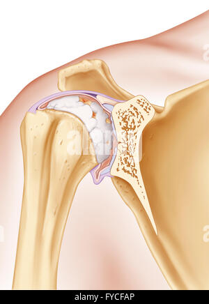 Osteoartrite, illustrazione Foto Stock