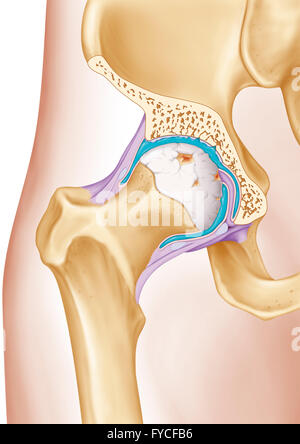 Trattamento di osteoartrite Foto Stock