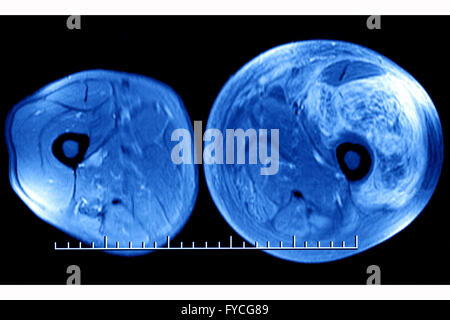Coscia ematoma, MRI Foto Stock