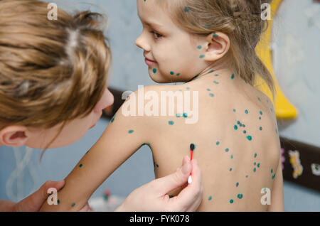 Bambina con la varicella piaghe cosparse zelenkoj Foto Stock