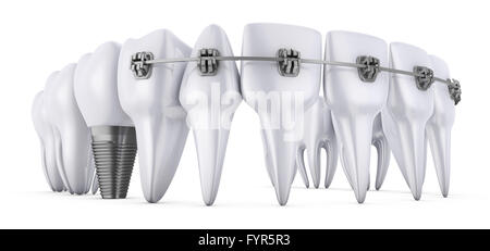 A denti con bretelle e gli impianti dentali, 3D render Foto Stock