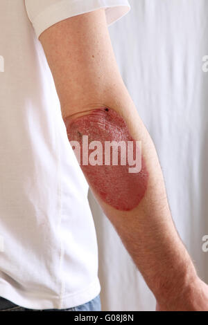 Persona affetta da psoriasi Foto Stock