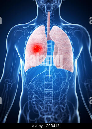 3d reso illustrazione del polmone maschio - il cancro Foto Stock