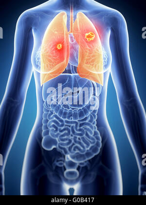3d reso illustrazione dell'anatomia femminile - il cancro ai polmoni Foto Stock